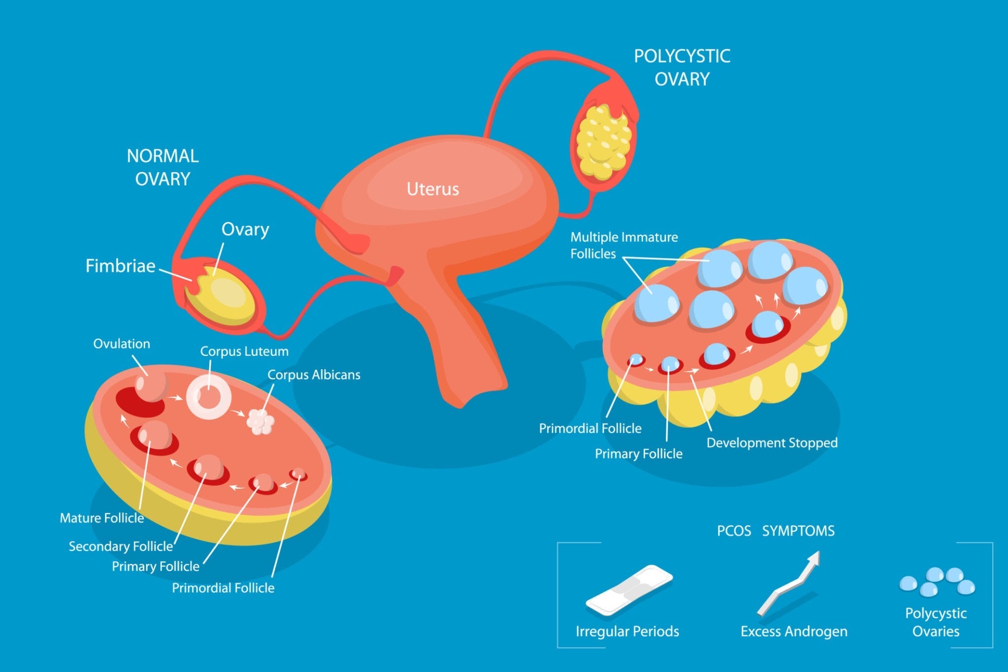 PCOS and Fertility: What You Need to Know When Trying to Conceive